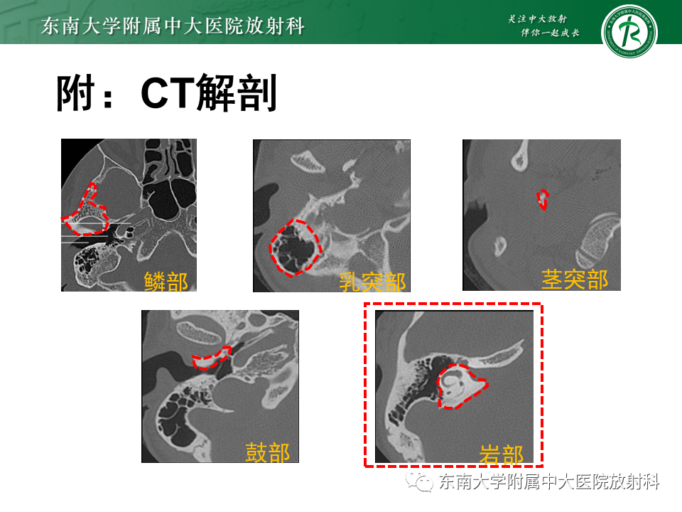 影像PPT - 【PPT】先天性耳发育畸形-37