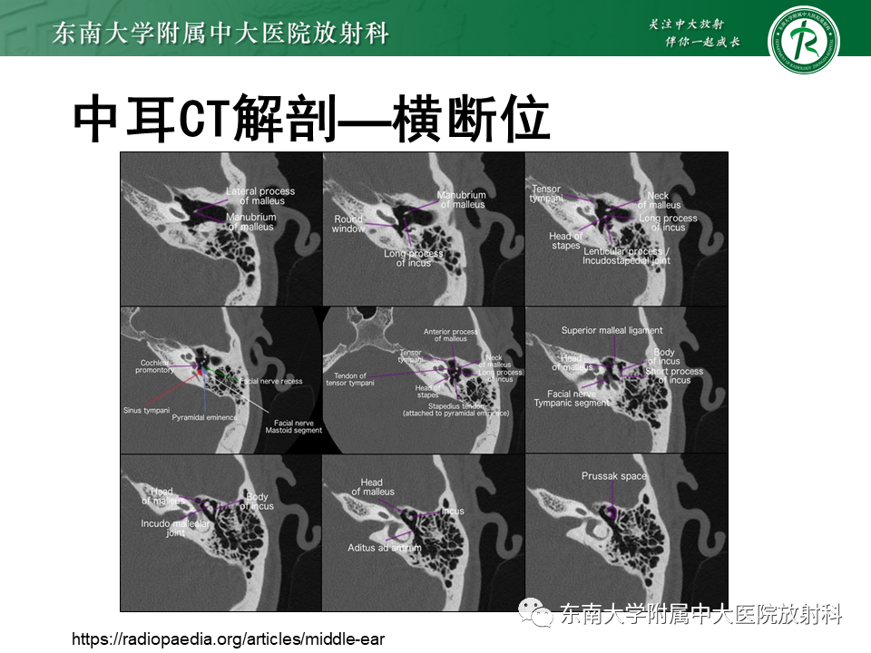 影像PPT - 【PPT】先天性耳发育畸形-38