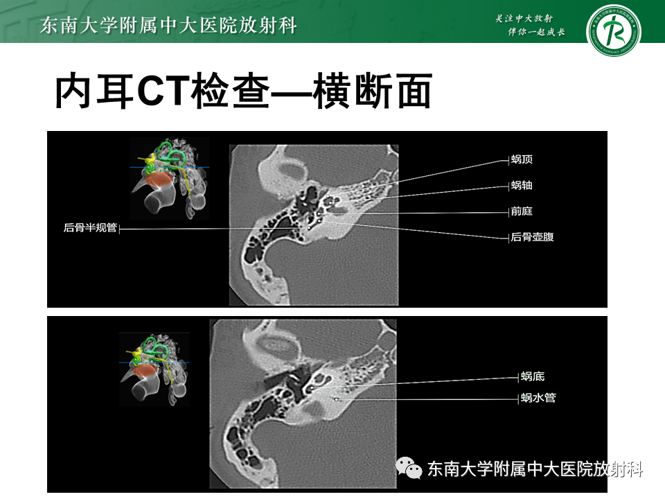 影像PPT - 【PPT】先天性耳发育畸形-41