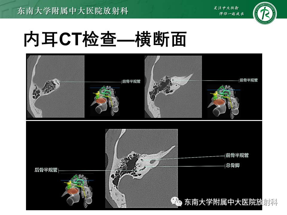 影像PPT - 【PPT】先天性耳发育畸形-39