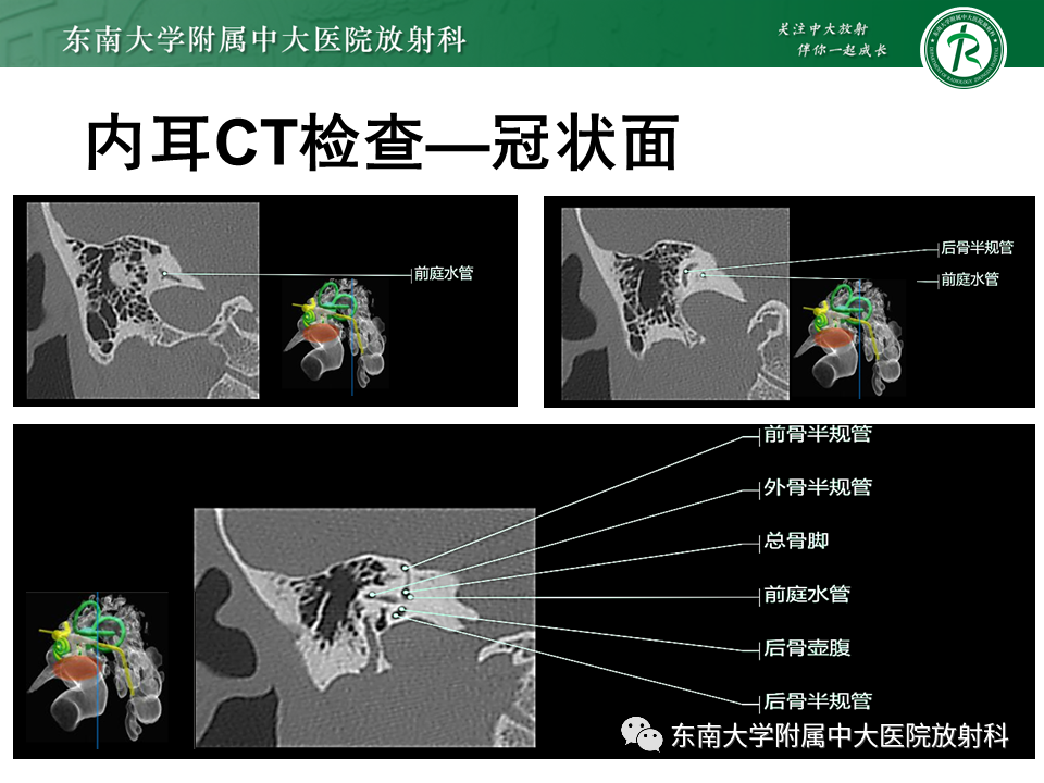 影像PPT - 【PPT】先天性耳发育畸形-43