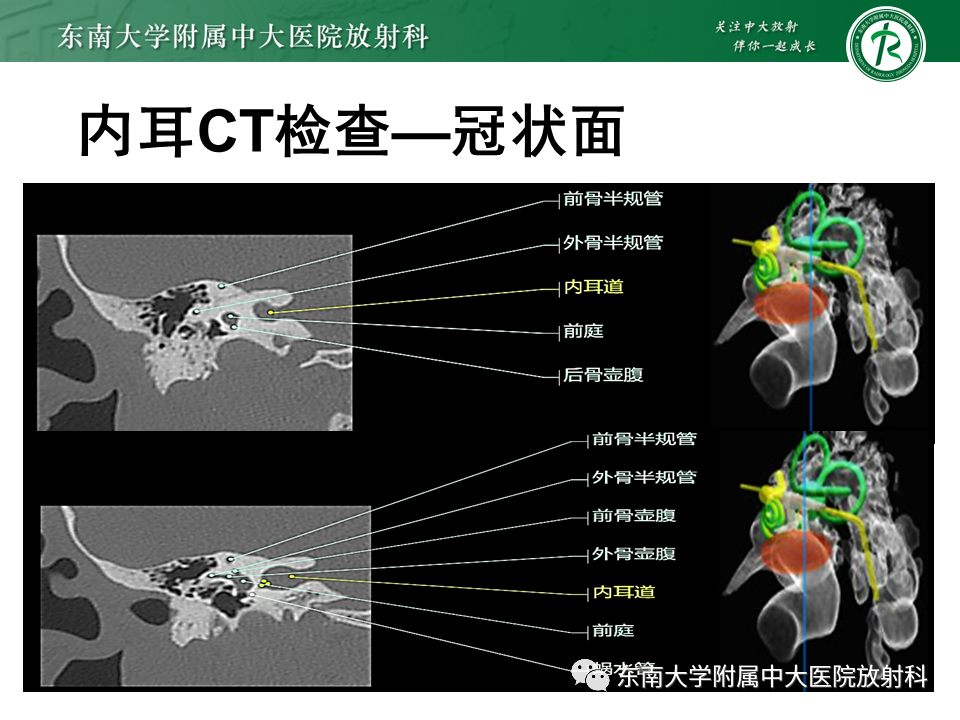 影像PPT - 【PPT】先天性耳发育畸形-44