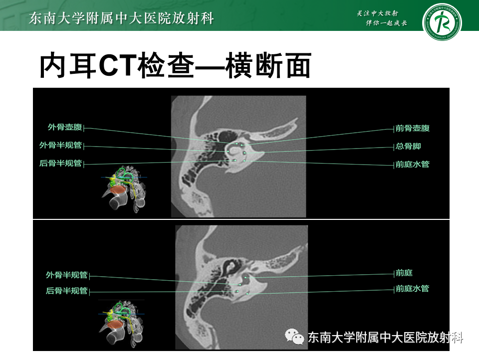 影像PPT - 【PPT】先天性耳发育畸形-40