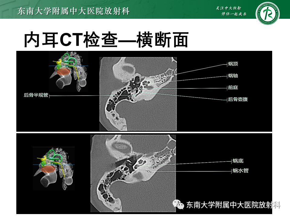 影像PPT - 【PPT】先天性耳发育畸形-42