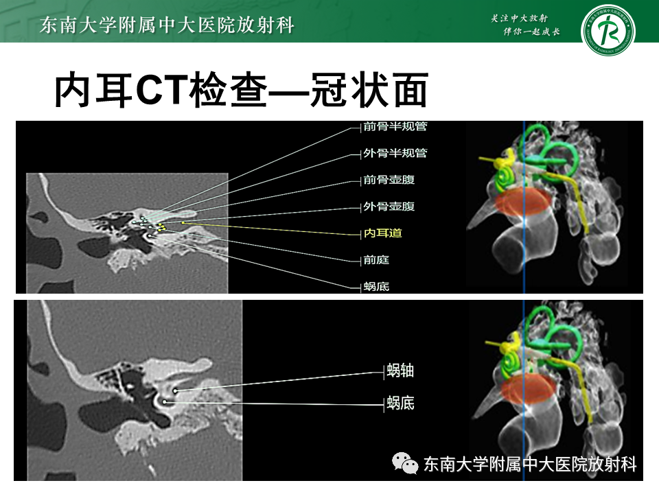 影像PPT - 【PPT】先天性耳发育畸形-45
