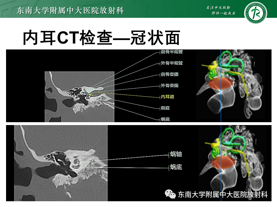 影像PPT - 【PPT】先天性耳发育畸形-46