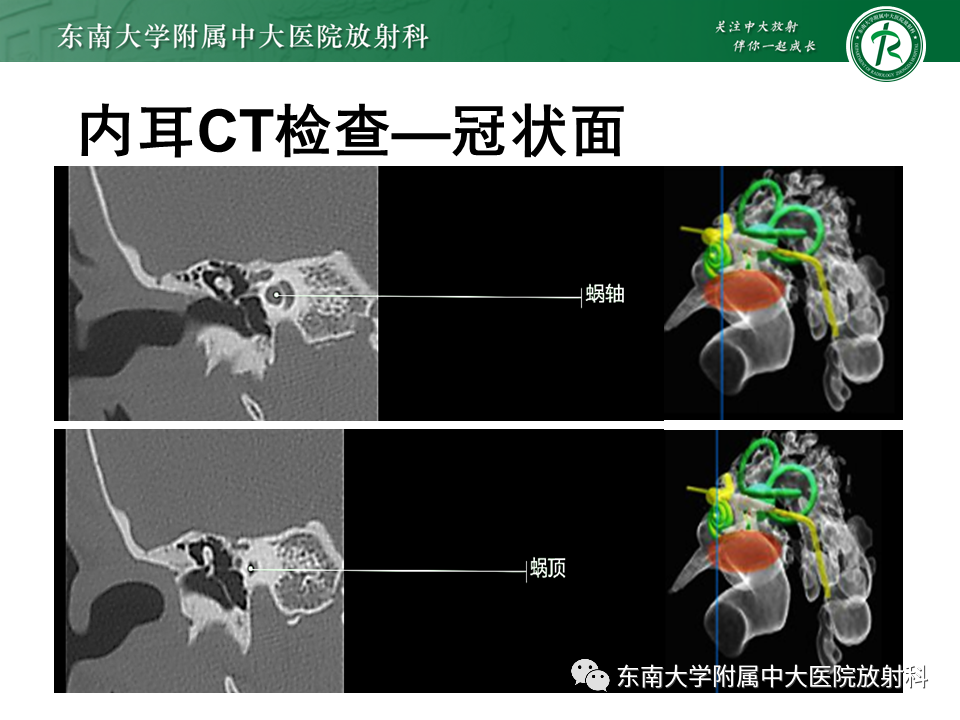 影像PPT - 【PPT】先天性耳发育畸形-47