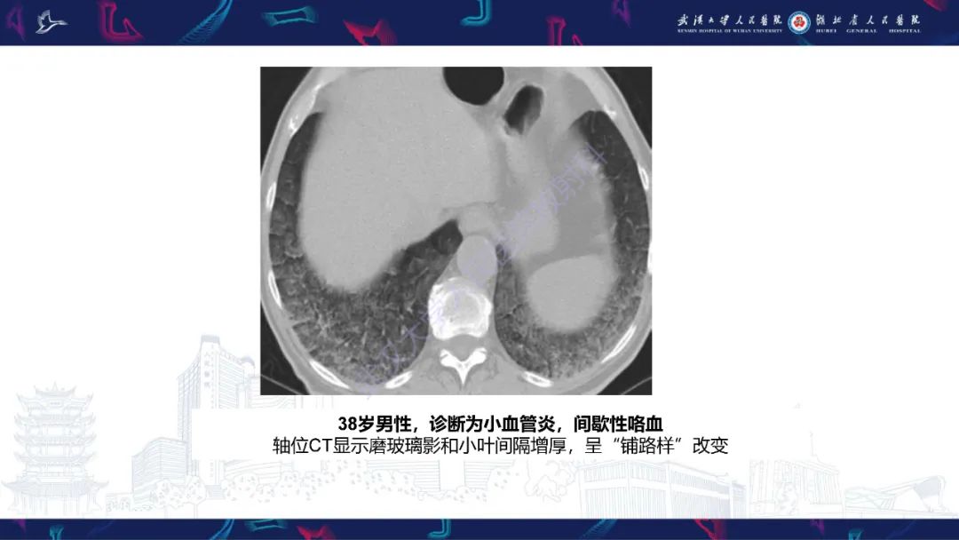 影像PPT - 【PPT】咯血CT评估-7