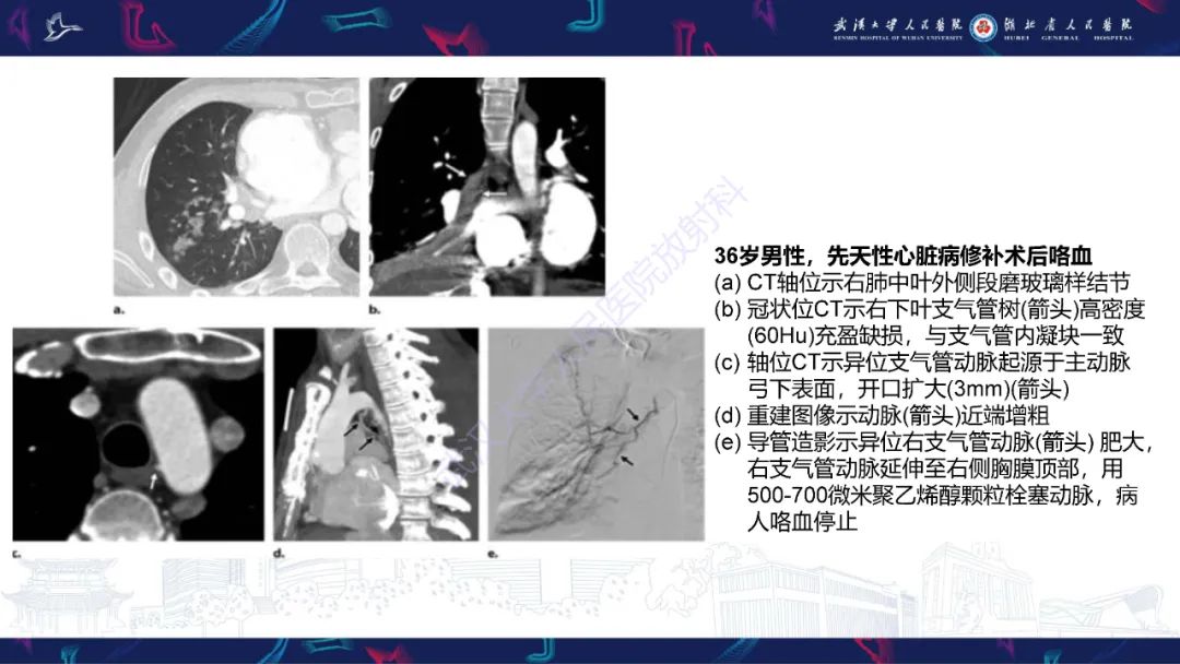 影像PPT - 【PPT】咯血CT评估-8