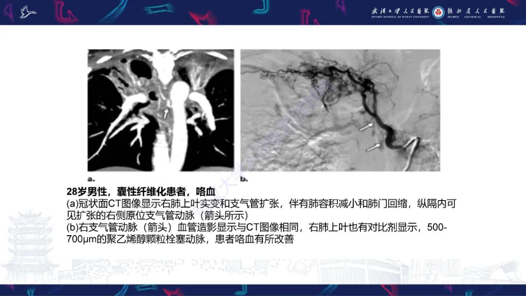 影像PPT - 【PPT】咯血CT评估-16