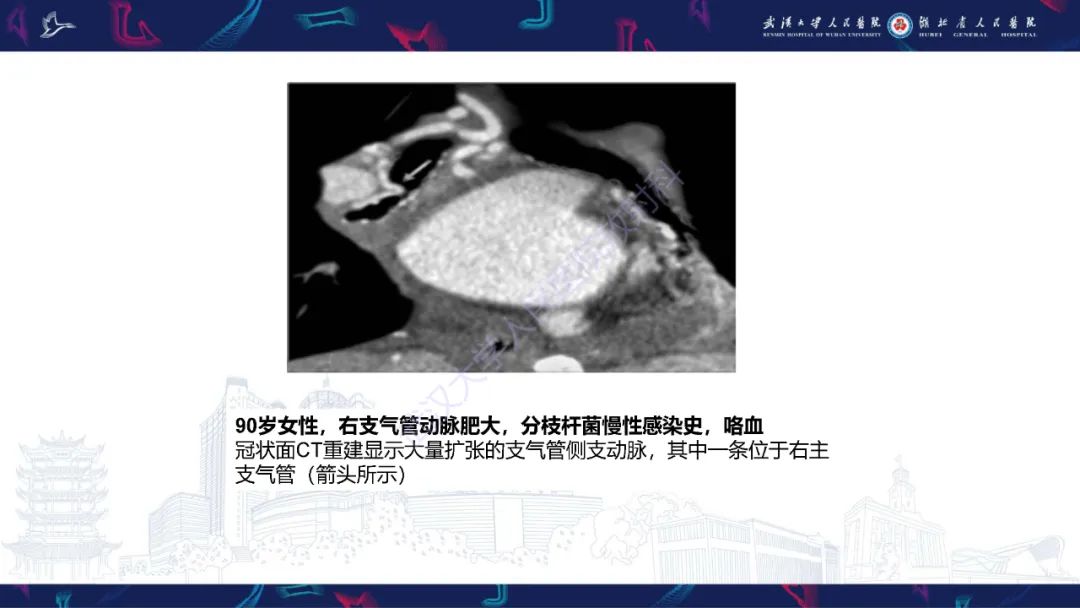影像PPT - 【PPT】咯血CT评估-17
