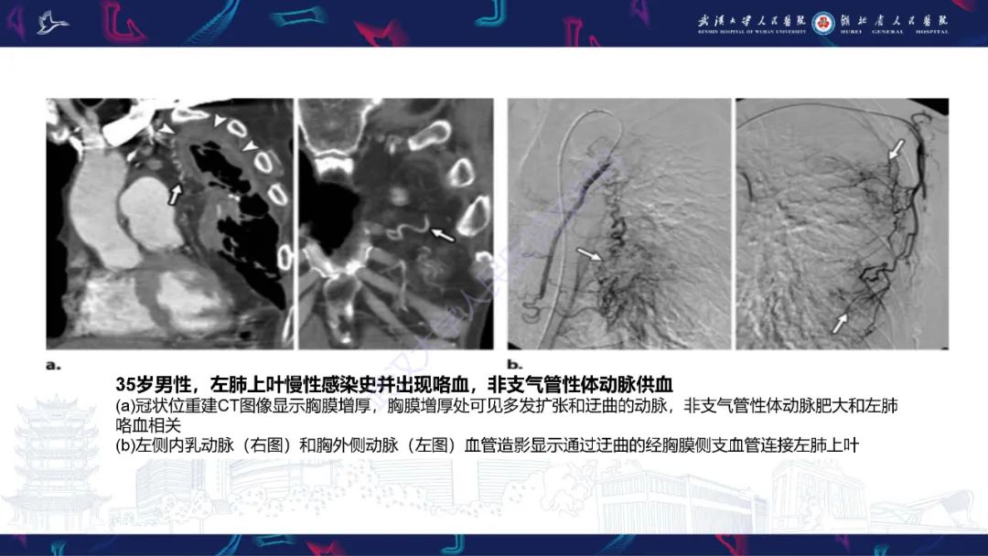 影像PPT - 【PPT】咯血CT评估-20