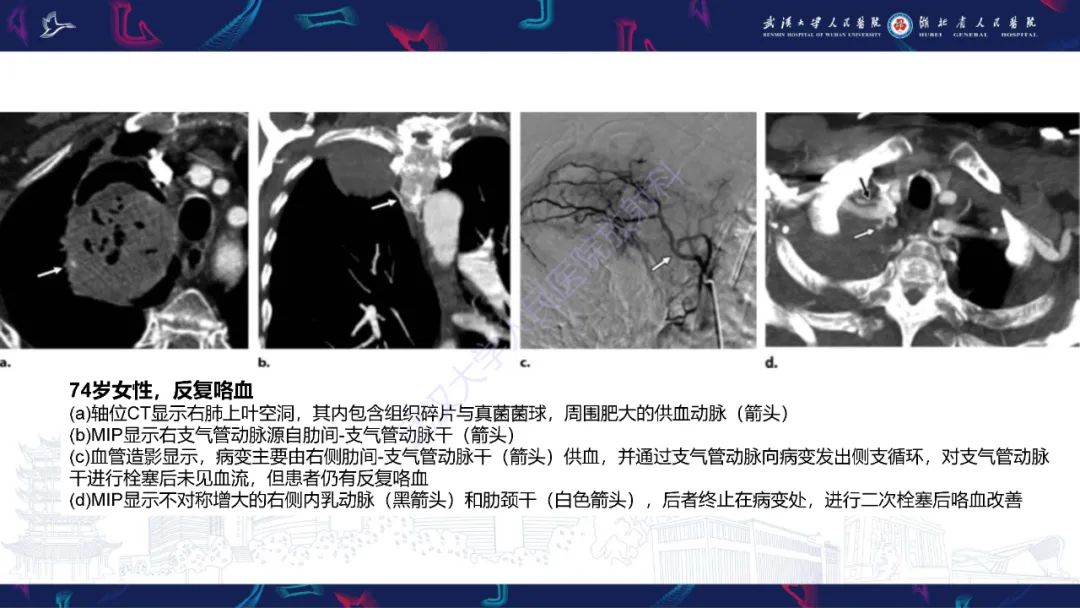 影像PPT - 【PPT】咯血CT评估-21