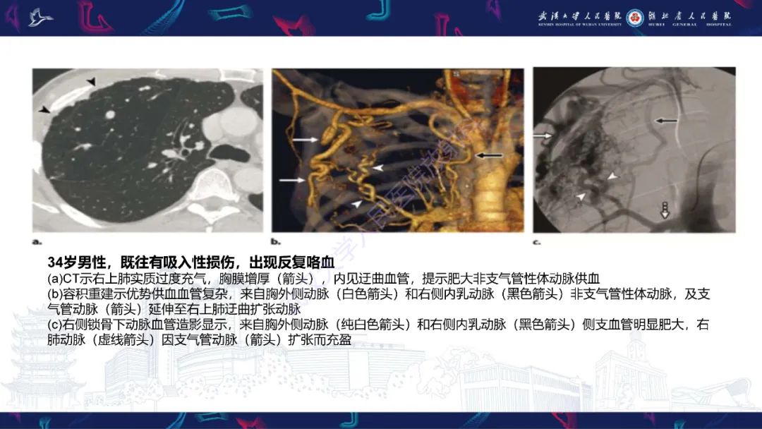 影像PPT - 【PPT】咯血CT评估-22