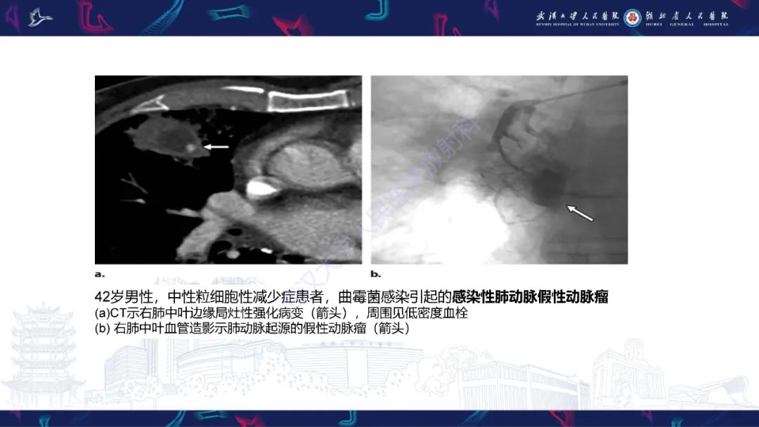 影像PPT - 【PPT】咯血CT评估-25