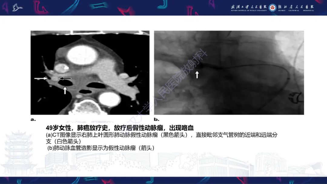 影像PPT - 【PPT】咯血CT评估-28