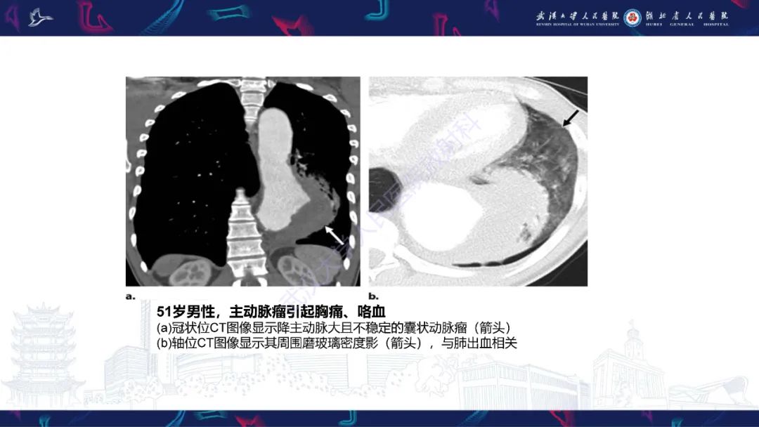 影像PPT - 【PPT】咯血CT评估-29