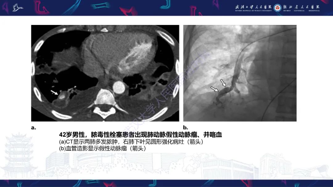 影像PPT - 【PPT】咯血CT评估-26