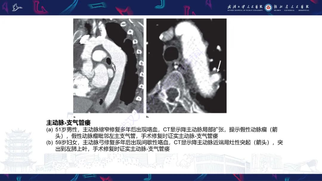 影像PPT - 【PPT】咯血CT评估-30