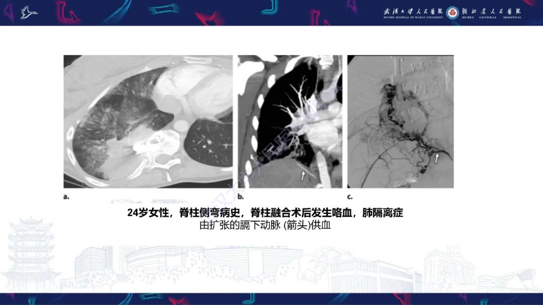 影像PPT - 【PPT】咯血CT评估-33
