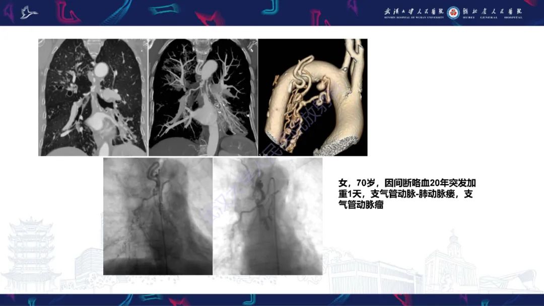 影像PPT - 【PPT】咯血CT评估-37