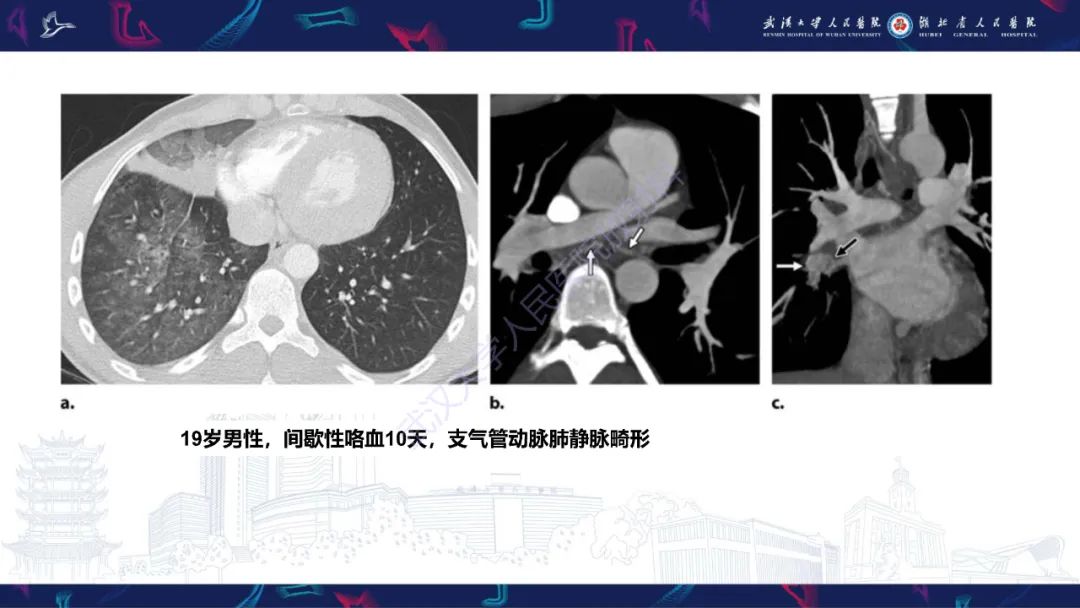 影像PPT - 【PPT】咯血CT评估-36
