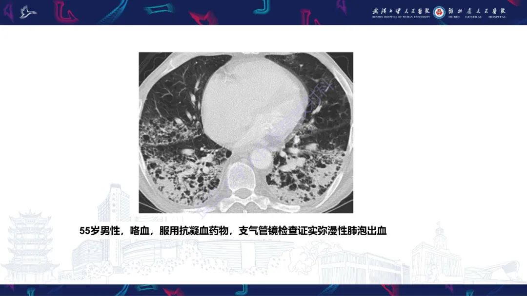 影像PPT - 【PPT】咯血CT评估-39