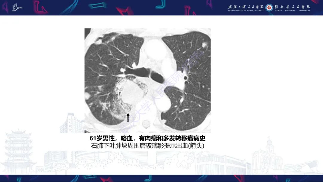 影像PPT - 【PPT】咯血CT评估-41