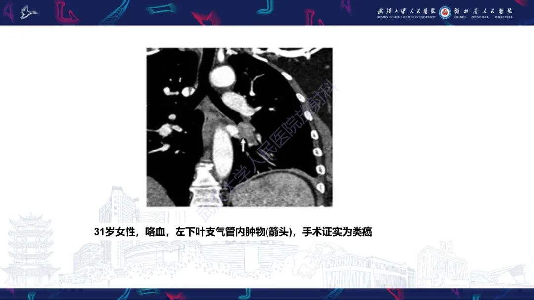 影像PPT - 【PPT】咯血CT评估-42