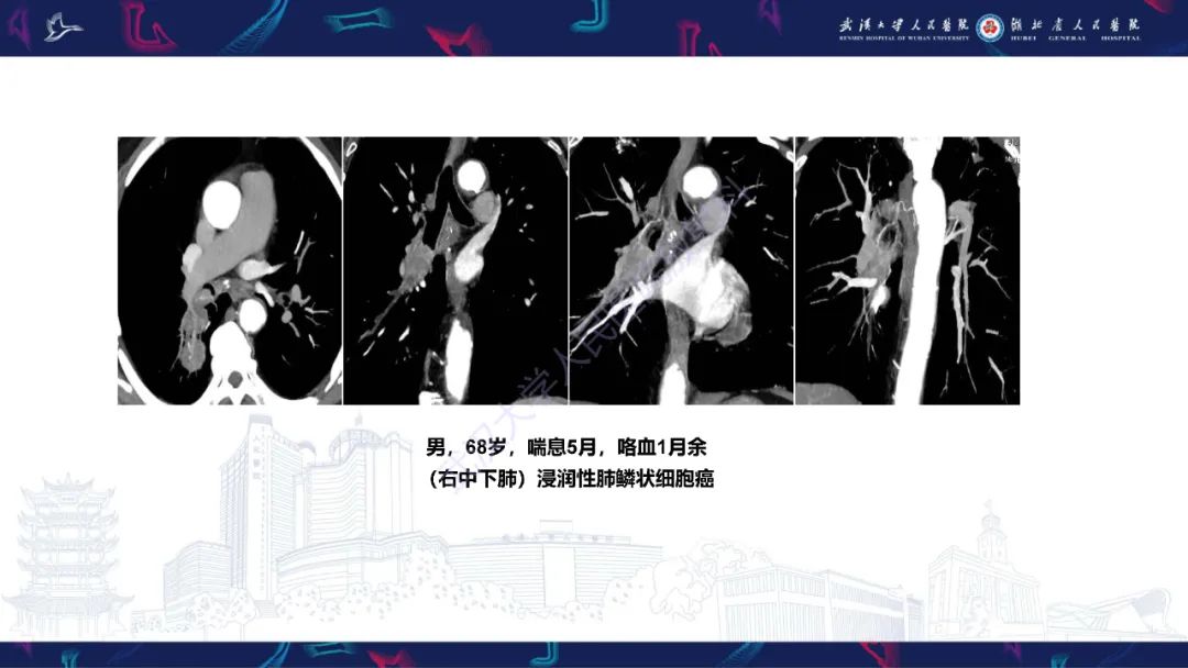 影像PPT - 【PPT】咯血CT评估-43
