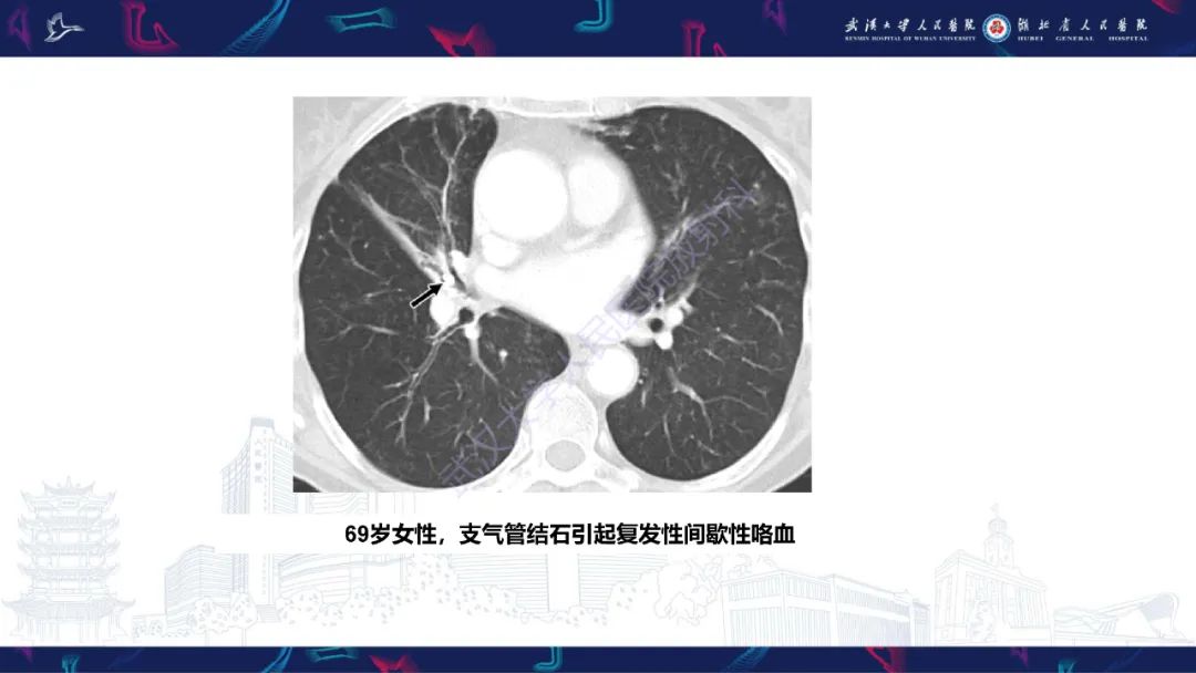 影像PPT - 【PPT】咯血CT评估-44