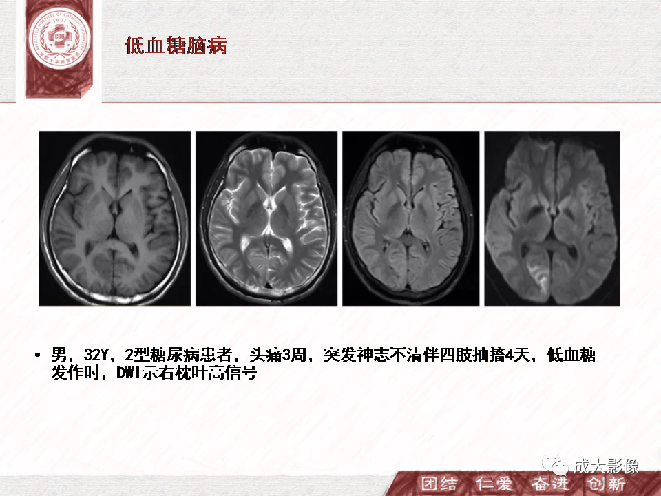 影像PPT - 【PPT】DWI示弥漫性脑皮质高信号病变的鉴别诊断-5