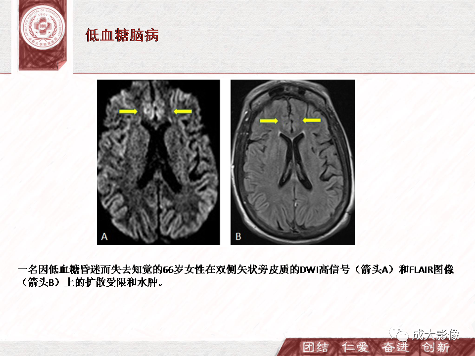 影像PPT - 【PPT】DWI示弥漫性脑皮质高信号病变的鉴别诊断-6