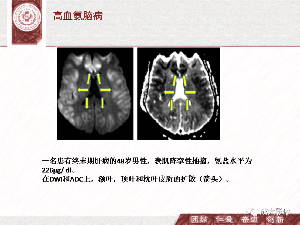 影像PPT - 【PPT】DWI示弥漫性脑皮质高信号病变的鉴别诊断-10