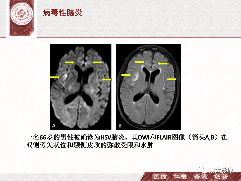 影像PPT - 【PPT】DWI示弥漫性脑皮质高信号病变的鉴别诊断-14