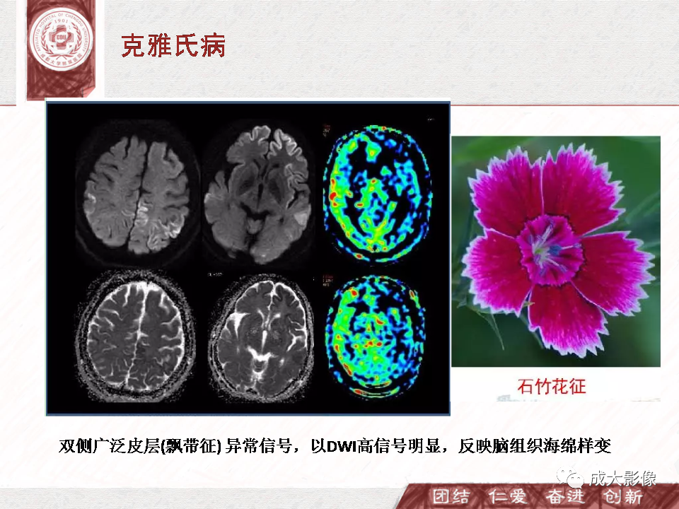 影像PPT - 【PPT】DWI示弥漫性脑皮质高信号病变的鉴别诊断-18