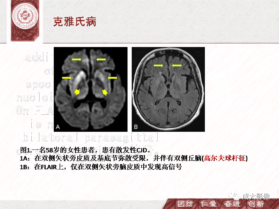 影像PPT - 【PPT】DWI示弥漫性脑皮质高信号病变的鉴别诊断-19
