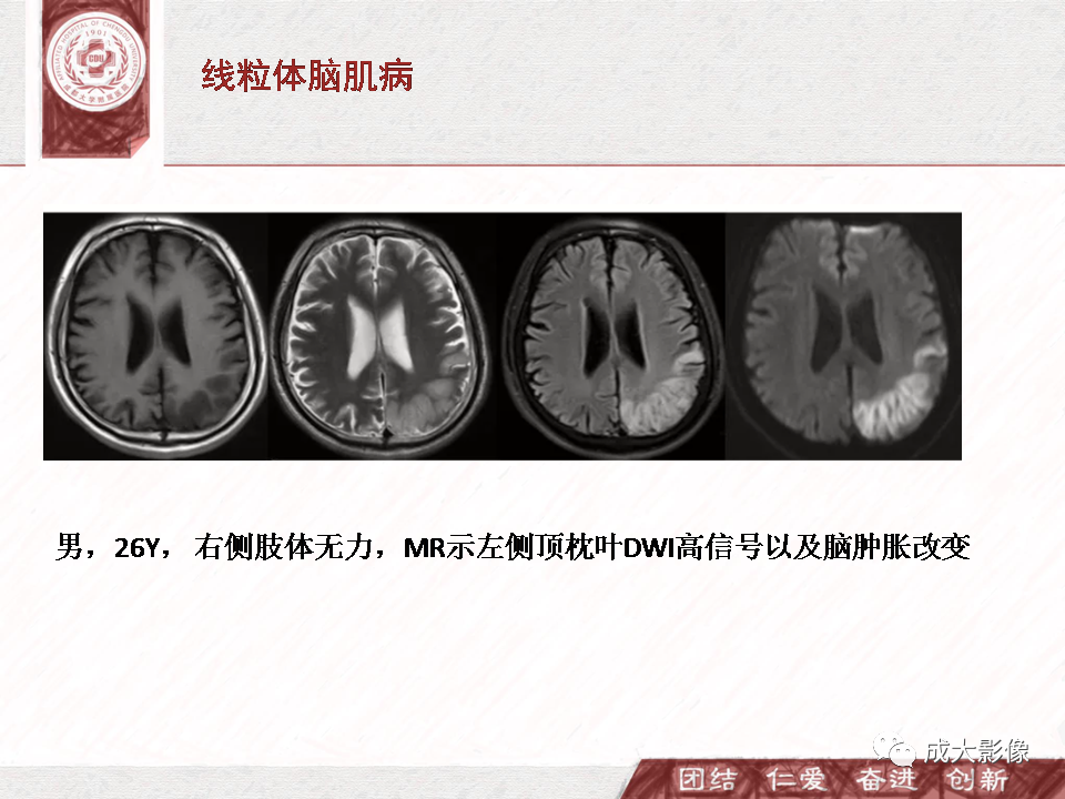 影像PPT - 【PPT】DWI示弥漫性脑皮质高信号病变的鉴别诊断-22