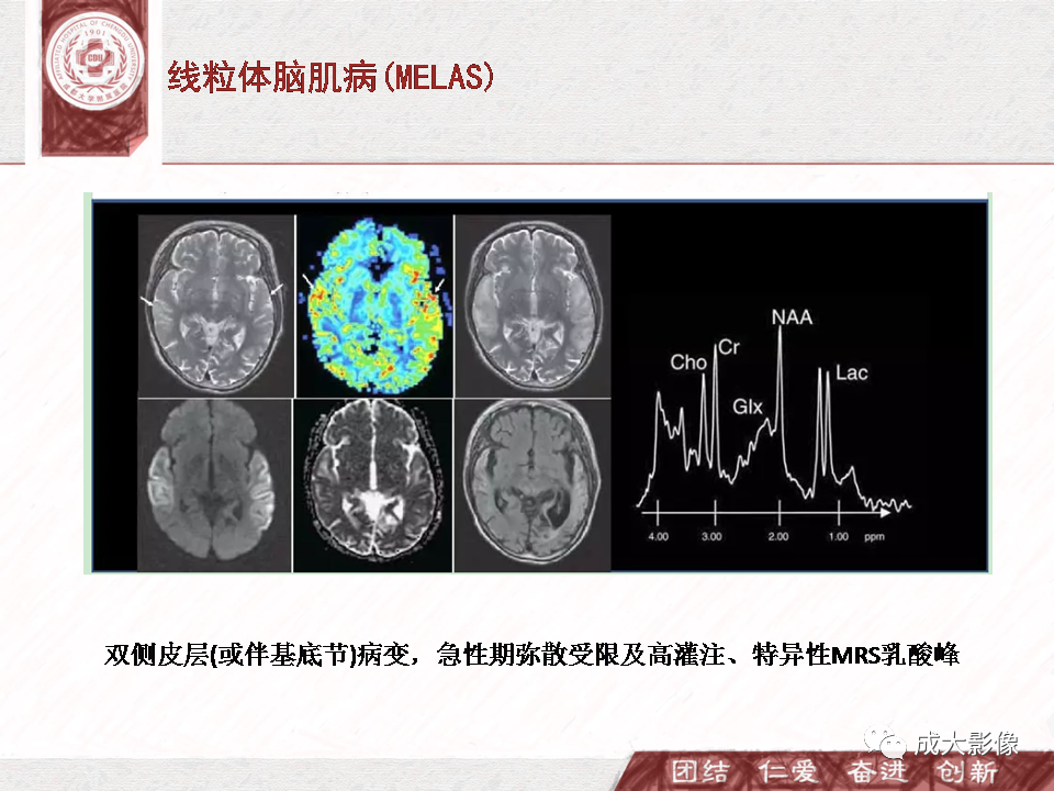 影像PPT - 【PPT】DWI示弥漫性脑皮质高信号病变的鉴别诊断-21