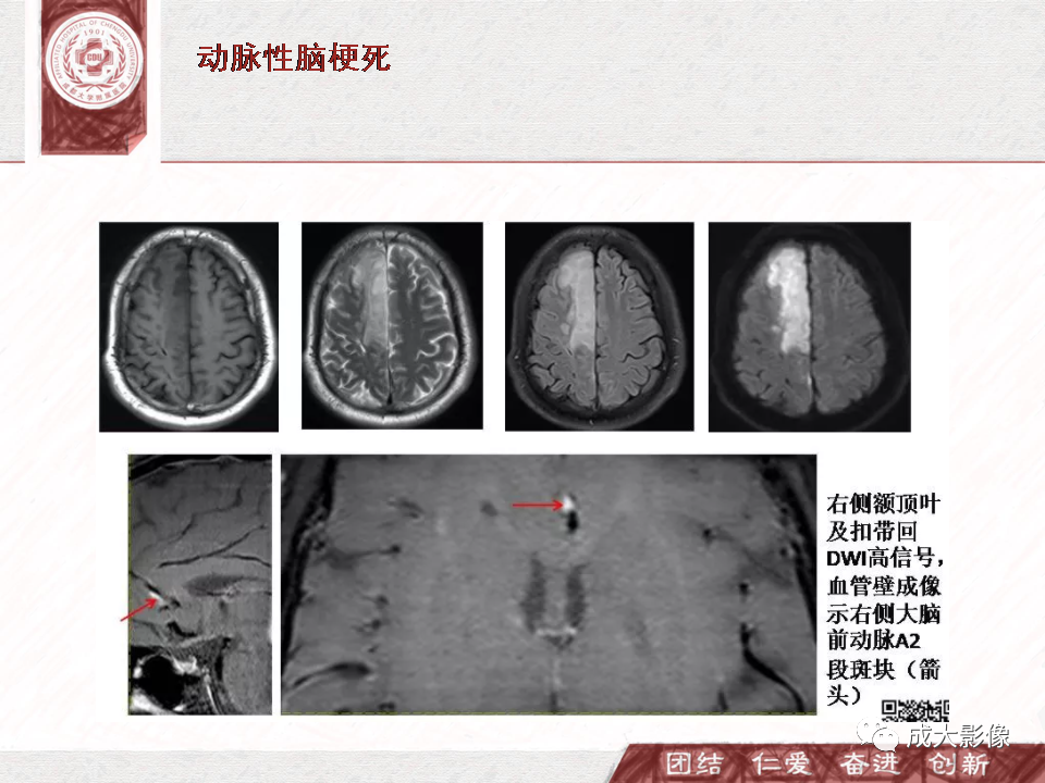 影像PPT - 【PPT】DWI示弥漫性脑皮质高信号病变的鉴别诊断-25