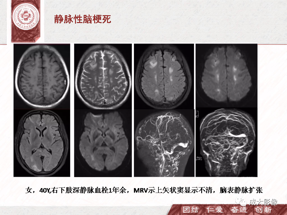 影像PPT - 【PPT】DWI示弥漫性脑皮质高信号病变的鉴别诊断-26