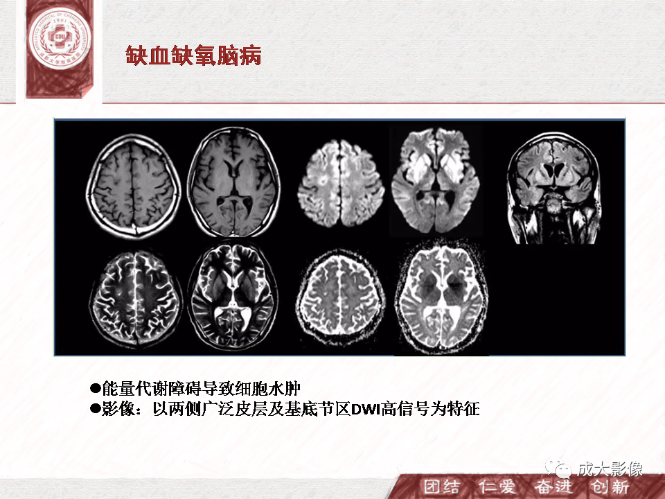 影像PPT - 【PPT】DWI示弥漫性脑皮质高信号病变的鉴别诊断-29