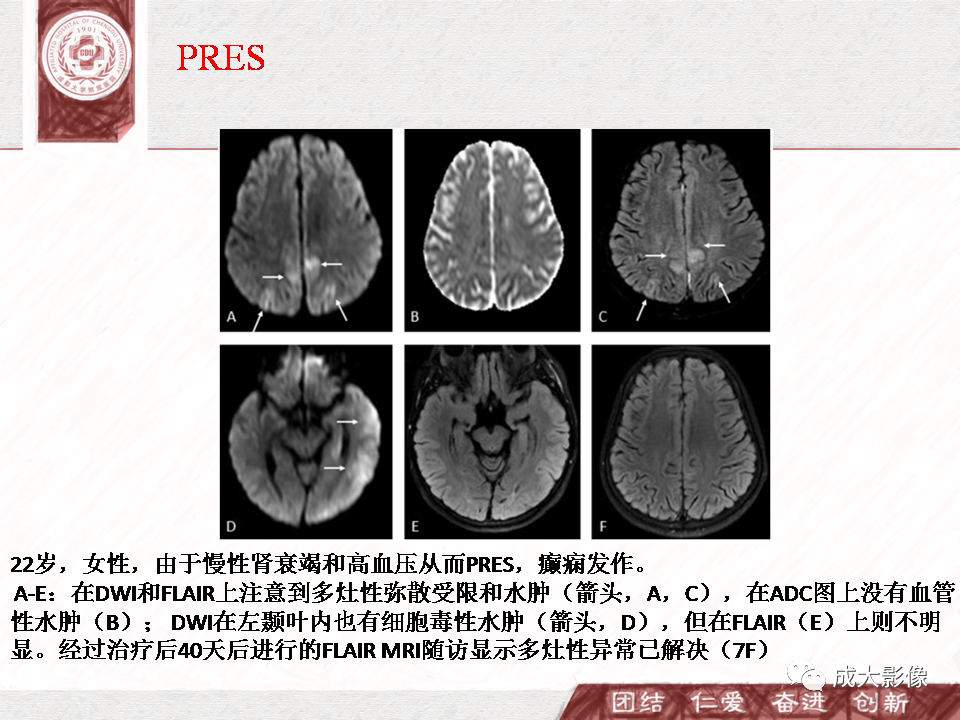 影像PPT - 【PPT】DWI示弥漫性脑皮质高信号病变的鉴别诊断-33