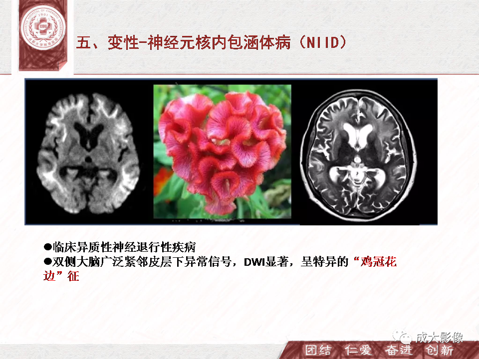 影像PPT - 【PPT】DWI示弥漫性脑皮质高信号病变的鉴别诊断-34