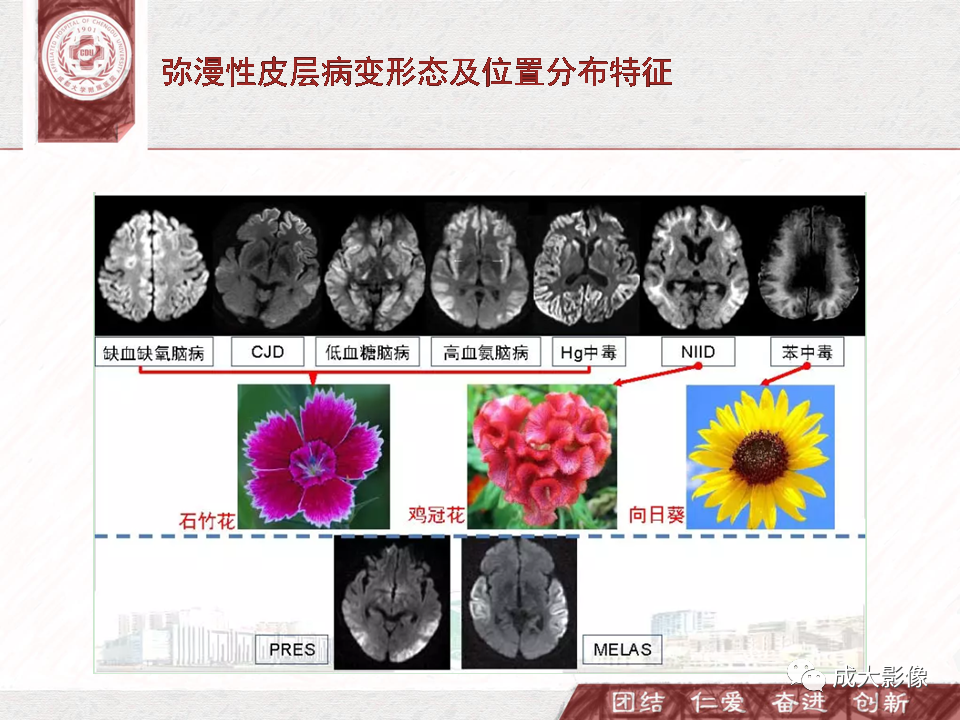 影像PPT - 【PPT】DWI示弥漫性脑皮质高信号病变的鉴别诊断-36