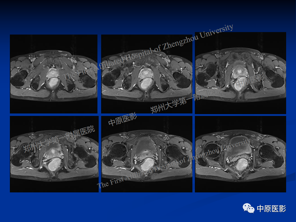 影像PPT - 【病例】直肠淋巴瘤1例MR影像-9