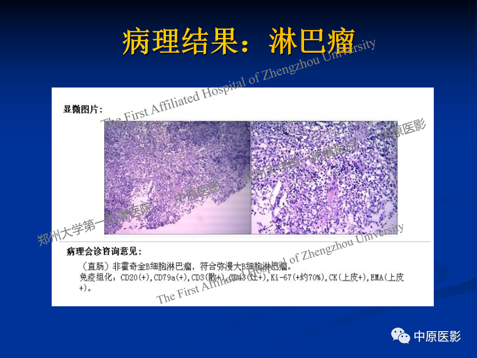 影像PPT - 【病例】直肠淋巴瘤1例MR影像-13