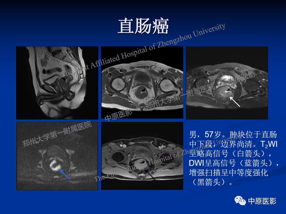 影像PPT - 【病例】直肠淋巴瘤1例MR影像-23