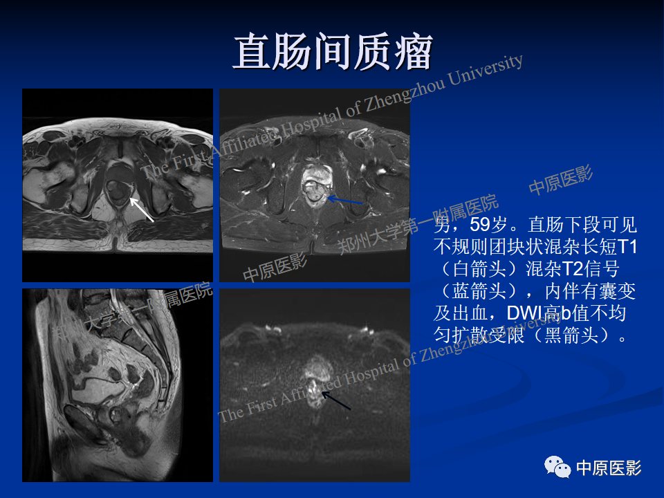 影像PPT - 【病例】直肠淋巴瘤1例MR影像-25
