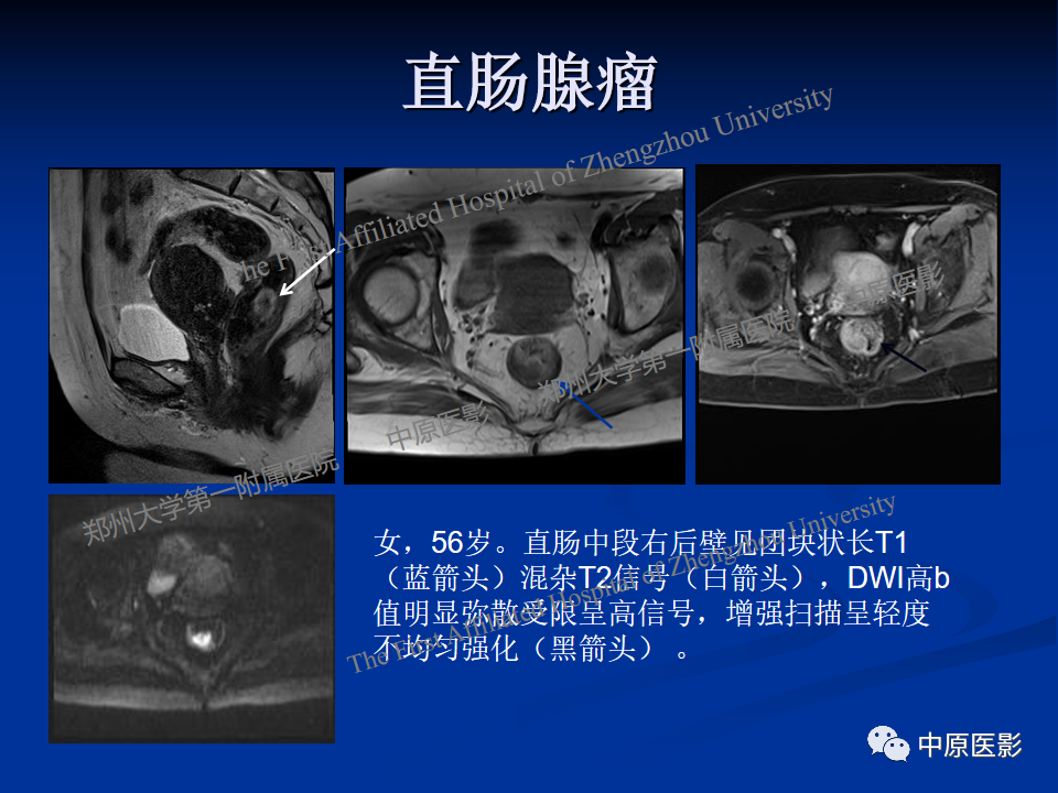 影像PPT - 【病例】直肠淋巴瘤1例MR影像-24